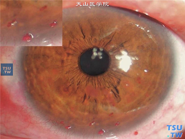 丝状角膜炎，干眼症患者发生丝状角膜炎，丝状物被虎红染成红色，同时可见角膜上皮亦有着色