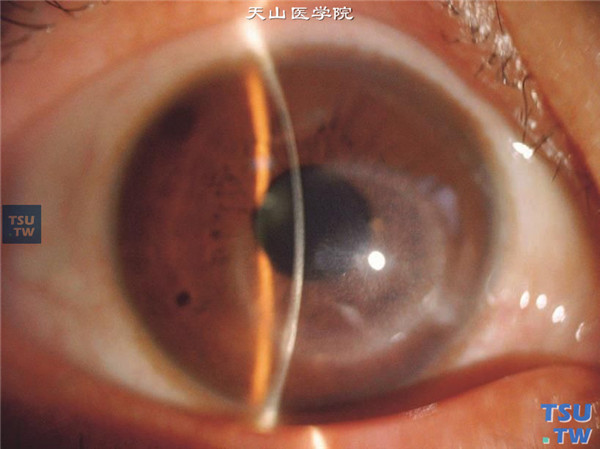 角膜基质炎，上图同一患者，裂隙灯显微镜检查，可见病变区角膜明显混浊水肿，角膜厚薄不均