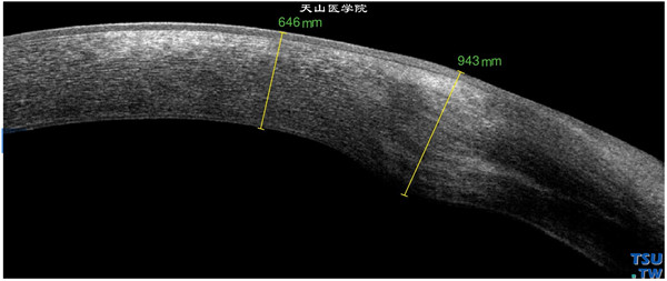 角膜基质炎，上图同一患者，RTvue OCT检查，显示角膜基质混浊水肿区影像密度高，厚度增加，但上皮层和内皮层影像线条尚连续完整，上皮层厚度增加