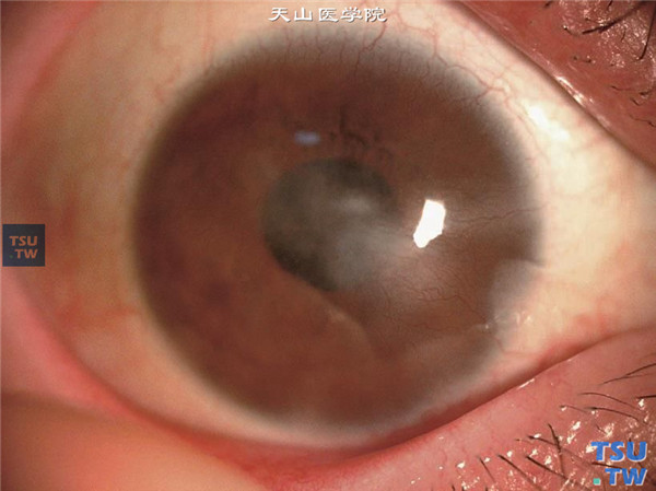 角膜基质炎，睫状充血，角膜基质炎性浸润，多量新生血管从角膜缘伸入炎症区内