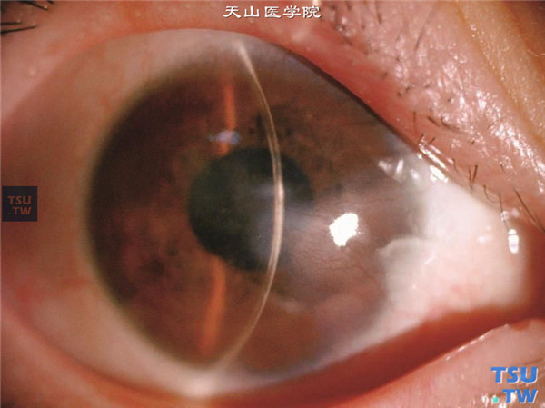 同一患者，裂隙灯显微镜检查，可见角膜炎症区全层混浊，新生血管也位于角膜深层，角膜厚度不均