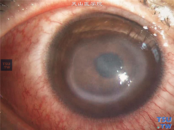 角膜基质炎，LASIK术后，可见明显的睫状充血，角膜瓣下弥漫性基质混浊水肿
