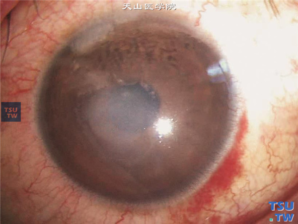 角膜基质炎，上图同一患者的左眼，睫状充血，瓣下角膜基质炎性浸润水肿，和右眼发生同样的角膜损害