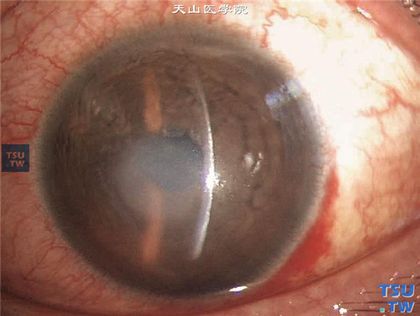 左眼，裂隙灯显微镜检查，显示手术区角膜基质水肿混浊