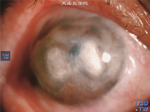 角膜基质炎，反复发作，可见角膜广泛的深层混浊，角膜中央区的混浊呈哑铃状，并伴有脂质样变性，深层血管深入角膜混浊区