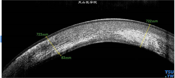 角膜基质炎，上图同一患者，RTvue OCT检查，可见角膜明显增厚，角膜内有哑铃状高密度致密影像