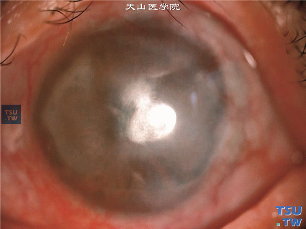 角膜基质炎，上图同一患者左眼，角膜基质炎反复发作，角膜内有与右眼相似的炎性混浊，中央区角膜脂质样变性，深层血管长入，血管充盈扩张