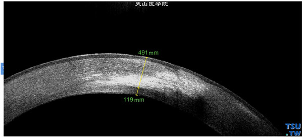 左眼RTvue OCT检查，显示角膜基质水肿增厚，角膜近中央病损区可见高密度致密影像