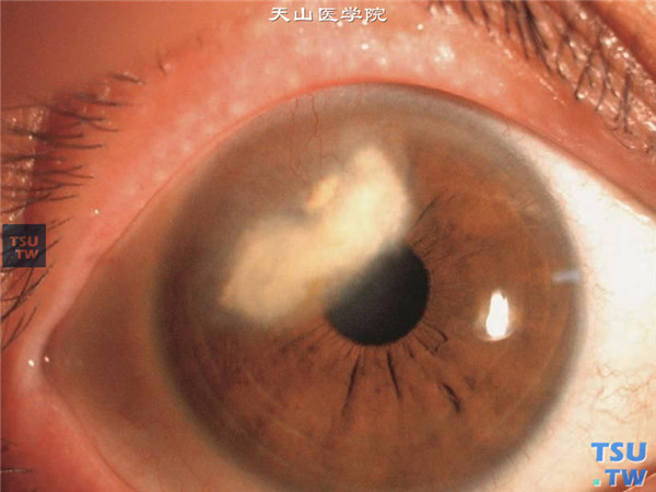 硬化型角膜基质炎典型症状1图
