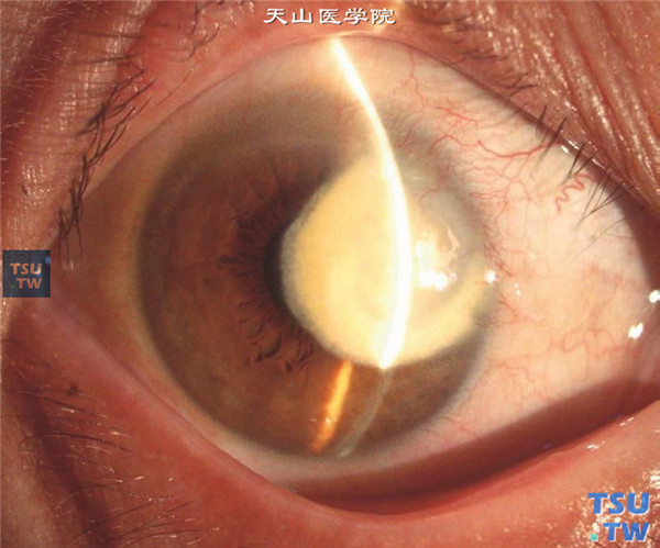 硬化型角膜基质炎典型症状2图