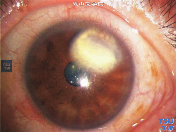 硬化型角膜基质炎典型症状3图