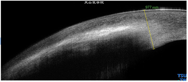 硬化型角膜基质炎，上图同一患者，RTvue OCT 检查，可见角膜明显增厚，角膜基质呈现密度不均致密的影像，病变累及角膜内皮层