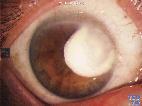 硬化型角膜基质炎，病变明显累及瞳孔区，病情发展较快，影响视力