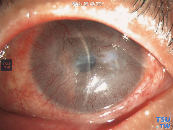 结角膜干燥，当病情严重时，角膜有多量血管长入，甚至形成血管膜覆盖角膜
