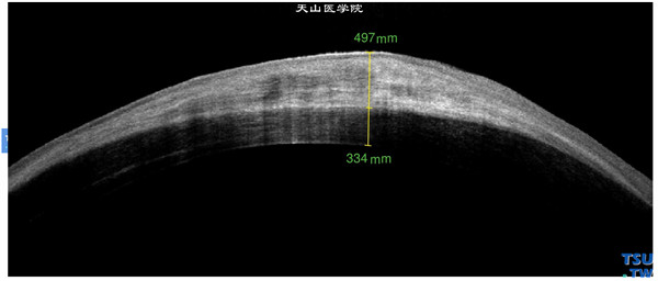 同一患者，RTvue OCT检查，角膜明显水肿增厚，角膜基质层内可见致密的、密度不均的影像，角膜上皮层欠完整
