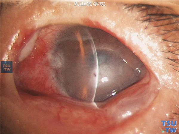结角膜干燥慢性期，上图同一患者另一患眼，结膜干燥，黏液性分泌物，结膜和角膜瘢痕形成，睑球粘连，下睑结膜部位有潴留囊肿