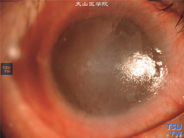 上述两张图片显示结角膜干燥双眼患者，角结膜严重干燥，角膜上皮角化，新生血管密集，形成血管膜覆盖角膜表面