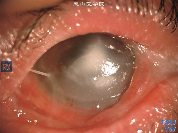 上述两张图片显示 结角膜干燥双眼患者，结膜瘢痕化，严重睑球粘连，角膜炎性溃疡，泪液分泌减少，黏液样分泌物