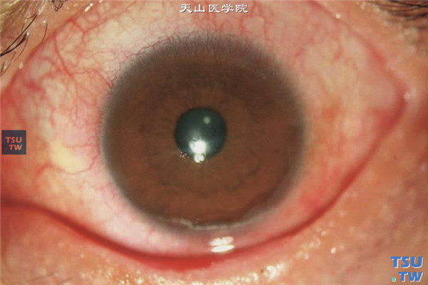 结角膜干燥，上图同一患者，局部应用糖皮质激素和环孢素滴眼液，药物治疗1周，病情缓解