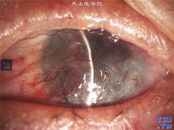 结角膜干燥左眼，患者13年病史，曾行羊膜移植术，角膜被血管膜覆盖，睑球粘连，伴有倒睫