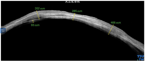 结角膜干燥，左眼RTvue OCT检查，角膜厚薄不均，最薄处角膜厚度只有285μm，角膜基质混浊，可见致密的、密度不均的影像，可见血管膜在角膜表面的影像和深度