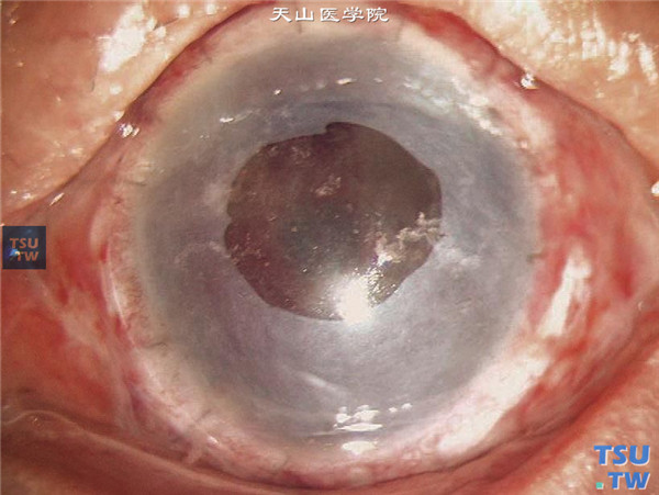 患者左眼行角膜新生血管膜切除联合带角膜缘组织的全板层角膜移植术，术中羊膜覆盖结膜和角膜，中心圆孔为剪除羊膜组织