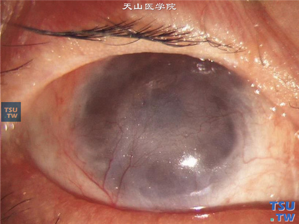 同一患者右眼，曾行羊膜移植术，3年前做过颌下腺移植和3次板层角膜移植术，病情暂时稳定，角膜植片混浊，新生血管长入植片