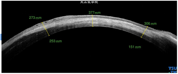 右眼RTvue OCT影像显示角膜变薄，厚薄不均，角膜上皮下细小水泡，角膜植床影像较角膜植片致密，可以判定植床和植片的界限