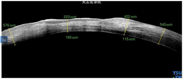 结角膜干燥，上图同一患者，RTvue OCT检查，显示角膜基质厚薄不均，角膜基质影像密度明显升高，但内皮层影像尚光滑连续