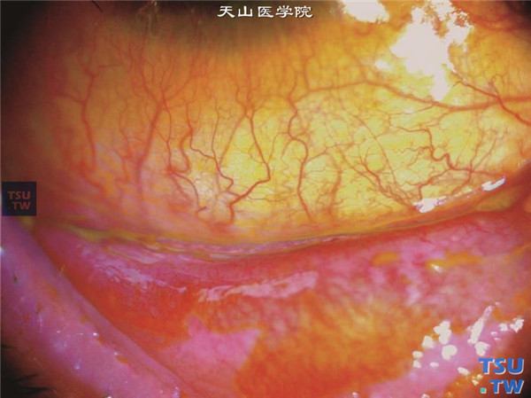 上述四张图片显示结角膜干燥同一患者，18年病史，结角膜干燥，角膜上皮角化，新生血管长入，睑结膜瘢痕形成
