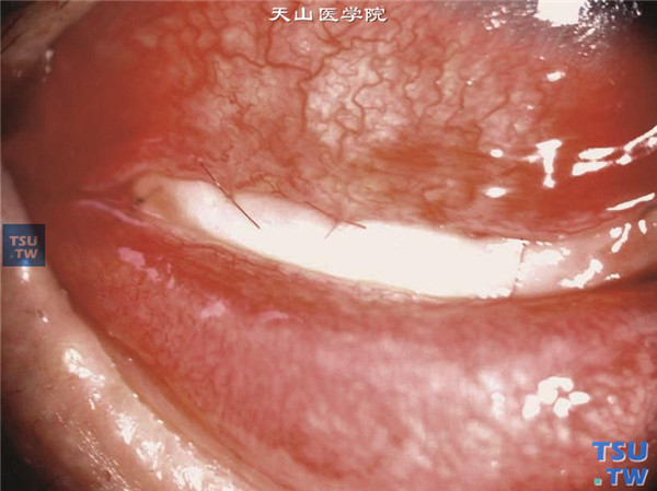 同一患者，行口腔黏膜唇腺移植术，患者自觉干燥症状减轻，泪液分泌试验从0mm变为4mm