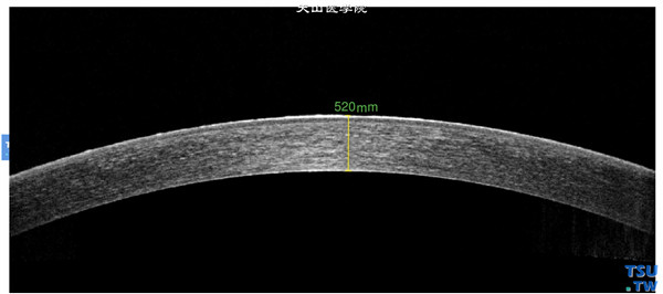 同一患者，RTvue OCT检查，可见角膜病变在上皮层，角膜上皮层欠光滑