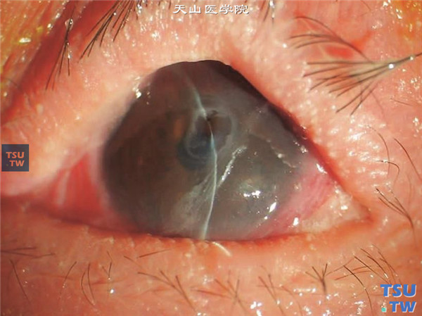 Sjögren综合征，结角膜干燥，角膜表面有黏液性分泌物附着，角膜中央无菌性溃疡，后弹力层膨出