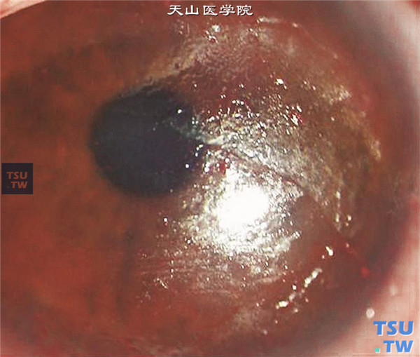 上述四张图片显示Sjögren综合征，结膜充血，结角膜干燥，角膜表面有明显丝状物，虎红染色阳性
