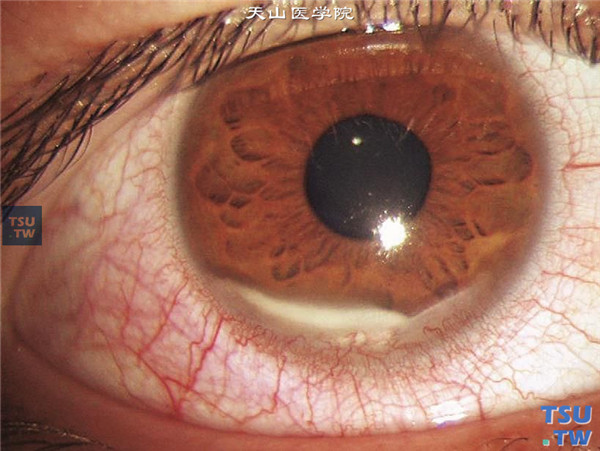 蚕食性角膜溃疡，表现为睫状充血，下方角膜缘内1/3象限角膜基质浸润，伴随新生血管长入