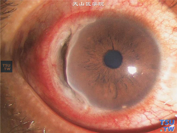 蚕食性角膜溃疡，混合充血，1/2象限角膜缘发生深层溃疡，十点位角膜穿孔