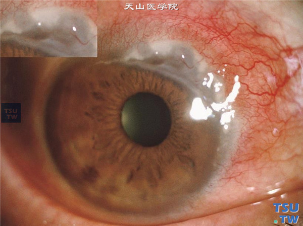 蚕食性角膜溃疡图片图片