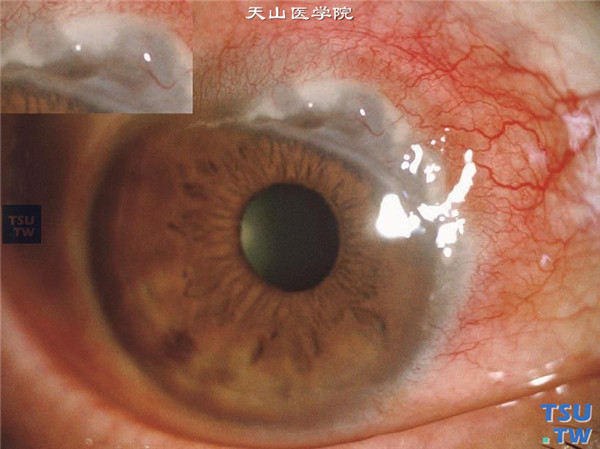 蚕食性角膜溃疡，混合充血，鼻上方角膜缘溃疡，溃疡边缘角膜水肿，混浊，周边血管膜形成
