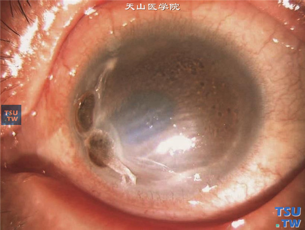 双眼蚕食性角膜溃疡患者，左眼病情发展迅速，合并角膜穿孔，虹膜脱出