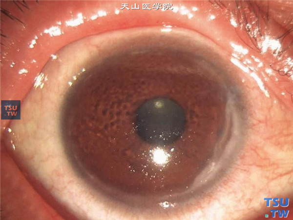 同一患者的右眼，角膜1/4象限性溃疡形成，角膜炎性浸润水肿
