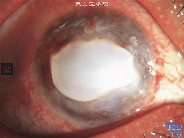 蚕食性角膜溃疡恶性型，病程进展迅速，溃疡迅速波及大部分角膜，伴有新生血管长入，角膜中央留有岛状混浊