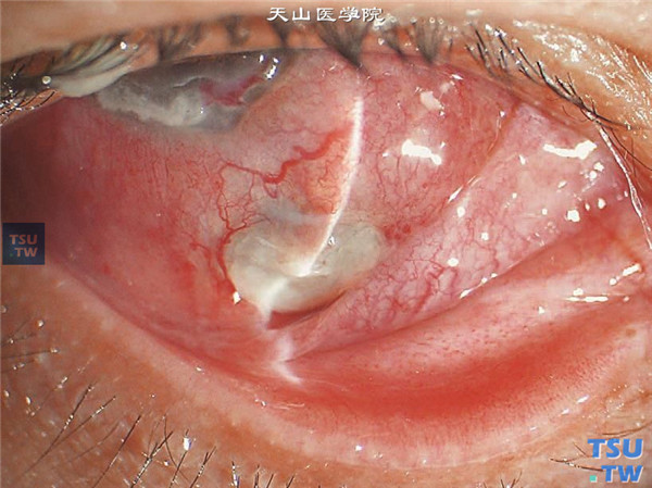 Wegener肉芽肿，上图同一患者，6点位角膜缘后结膜和巩膜炎性浸润，坏死，表面有坏死组织的膜状物覆盖