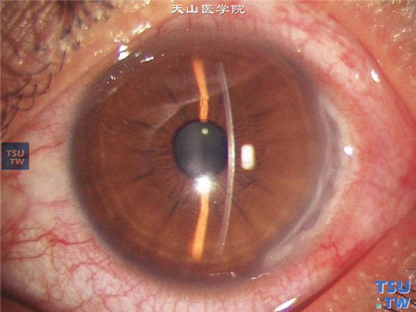 蚕食性角膜溃疡，表现为角膜缘溃疡为象限性损害，伴有混合充血