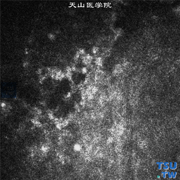 HSK内皮型，上图同一患者，临床共聚焦显微镜检查，角膜水肿区内皮细胞边界不清，无六边形内皮细胞轮廓，在内皮层聚集炎性细胞，表现为高强度反光图像 ×1000