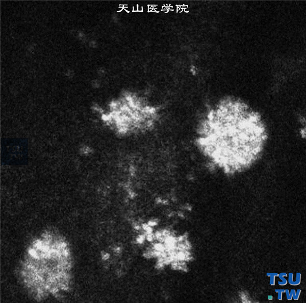 HSK内皮型，上图同一患者，临床共聚焦显微镜发现，角膜内皮层细胞边界不清，簇状高强度反光图像为大量炎性细胞聚集的KP × 1000