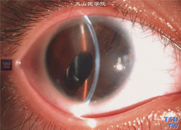 眼前节毒性反应综合征（TASS），同一患者，术后随访2年，局部角膜水肿，瞳孔变形，眼压正常，视力0.7