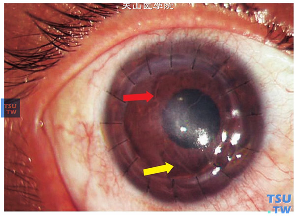 患者因真菌性角膜溃疡，行穿透角膜移植术，术后15个月发生内皮型免疫排斥反应，可见内皮排斥线（红色箭头）和后弹力层皱褶（黄色箭头）