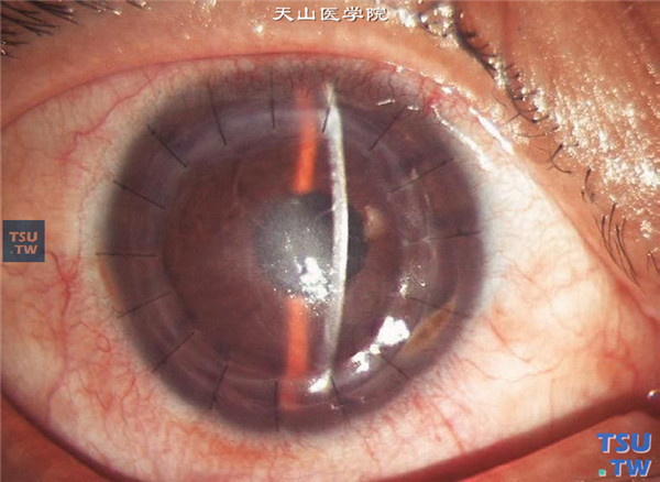 同一患者，裂隙灯显微镜检查，可见角膜植片弥漫性水肿，后弹力层皱褶和内皮排斥线的断面呈点状混浊