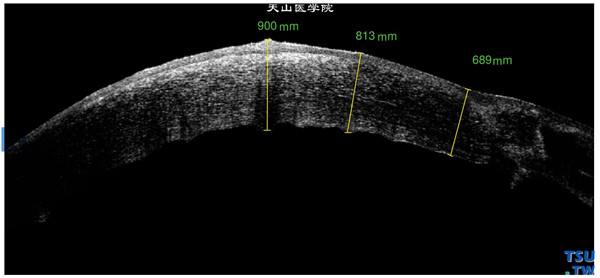 同一患者，RTvue OCT 检查，角膜植片基质层影像密度增高，上皮层水肿，内皮层界线粗糙，凹凸不平