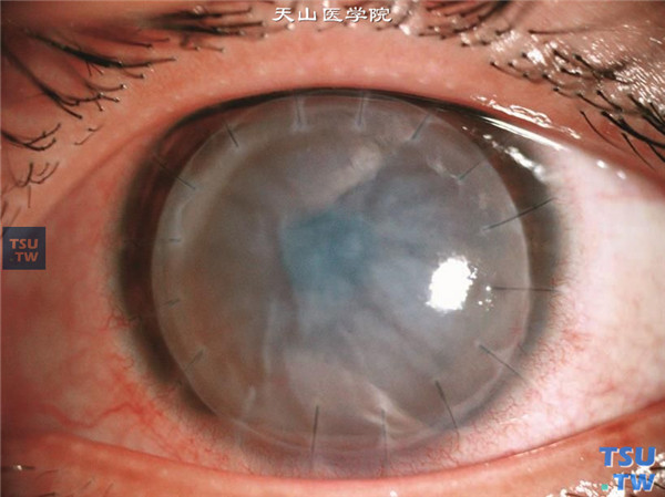 角膜移植术后内皮型免疫排斥反应